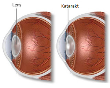 Cataract